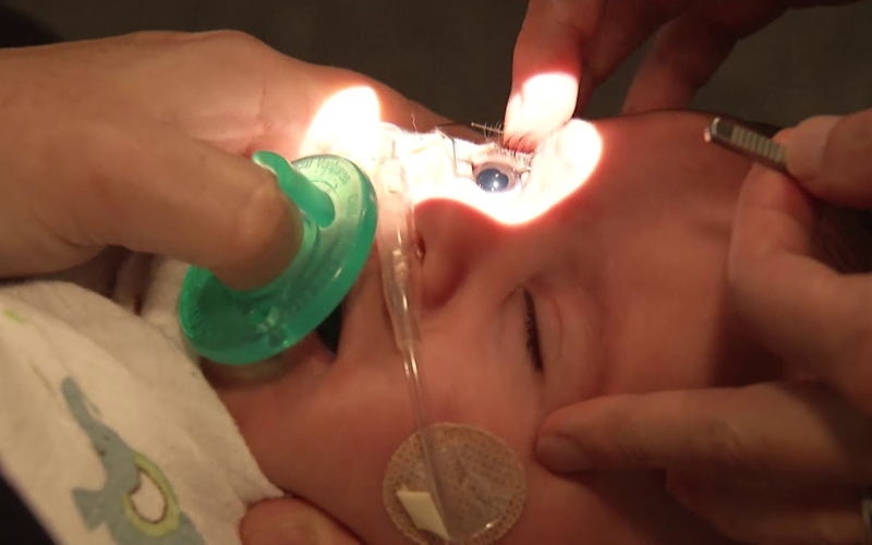 Premature Baby Retina Check up