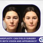 Eyelid Surgery