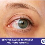 Dry Eyes - Causes and Symptoms